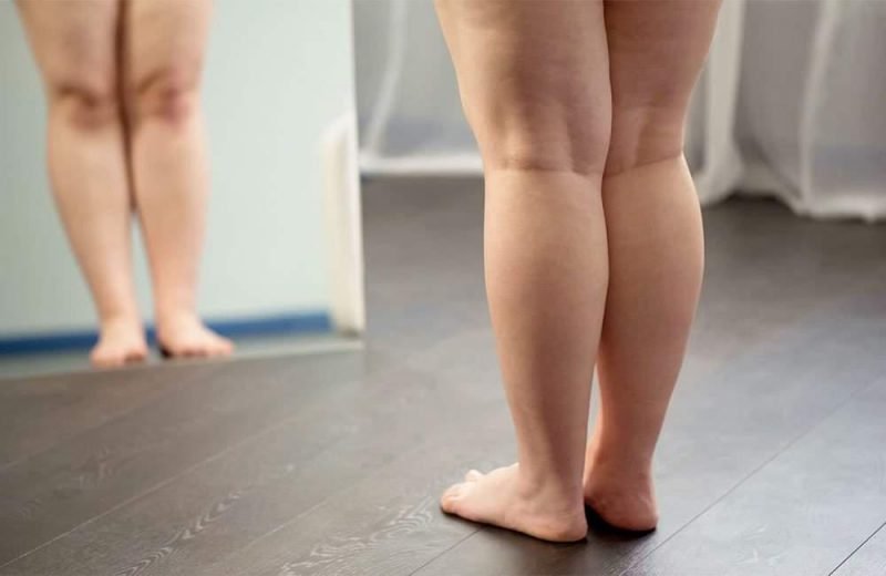 Falta de conscientização sobre lipedema é problema no combate à doença; saiba 5 sinais para prestar atenção
